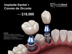 Implantes Dentales