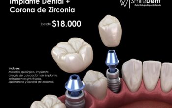 Implantes Dentales